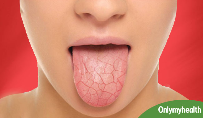 मुंह सूखने के पीछे हो सकते हैं ये 5 कारण, जानें किन बीमारियों का है ये संकेत